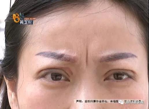 30多岁女子想去做主播 双眼皮手术后:没信心了